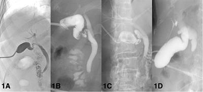 Management of Patients With <mark class="highlighted">Acute Cholecystitis</mark> After Percutaneous Cholecystostomy: From the Acute Stage to Definitive Surgical Treatment